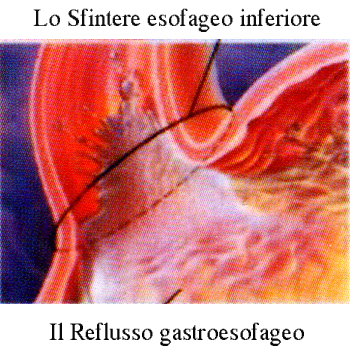 sfintere-esofageo-inferiore